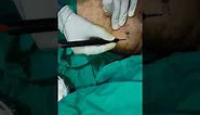 #radiofrequency wart removal#genital wart #condyloma #shorts
