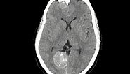 Falx meningioma: MRI brain