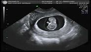 FIRST PREGNANCY ULTRASOUND (Gender "confirmed" with 9 weeks?)