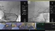 Stent-assisted coil embolization of MCA aneurysm via a trans-posterior communicating artery access