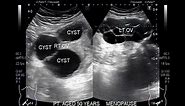 Ultrasound Video showing bilateral Ovarian multilocular cysts.