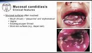 Candida: Mucosal candidiasis