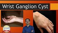 Ganglion Cyst of Wrist. Small Lump over Wrist