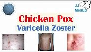 Chickenpox | Varicella Zoster Virus | Pathogenesis, Signs and Symptoms, Diagnosis, and Treatment