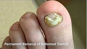 Permanent toenail removal | Dr. Nick Campitelli