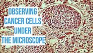 Observing Cancer Cells Under The Microscope