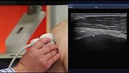 Imaging the Shoulder Using the Aplio i800 Ultrasound