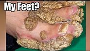 Thickest Feet Skin, Palmoplantar Keratoderma (PPK)