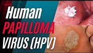 Human Papilloma Virus (HPV) - Signs, Symptoms, Causes, treatment and Can it be Cured?