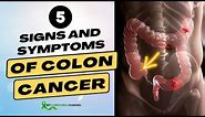 5 Signs and Symptoms of Colon Cancer