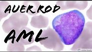 Acute Myeloid Leukemia (Auer Rod in a Blast) on Peripheral Blood Smear: Hematopathology & Hematology