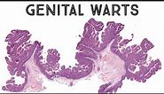 Genital warts under microscope (condyloma acuminatum HPV pathology dermpath dermatology)