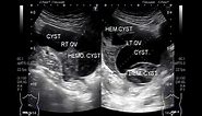 Bilateral Multiple Ovarian Cysts and Ovarian Mass.