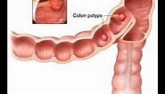 What is a Colon Polyp? | Los Angeles Colonoscopy