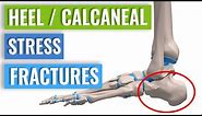 Heel/Calcaneal Stress Fracture: Causes, Symptoms & Treatment