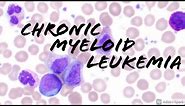 Chronic Myeloid Leukemia (CML) Peripheral Blood Smear (Hematopathology & Hematology)