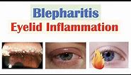Blepharitis (Eyelid Inflammation) | Causes, Risk Factors, Signs & Symptoms, Diagnosis, Treatment