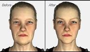Facelift & Neck Lift surgery - Dr. Julian De Silva - 3D medical animation