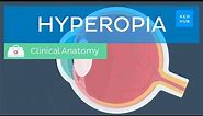 Farsightedness (Hyperopia): Definition, causes, symptoms, diagnosis and treatment | Kenhub