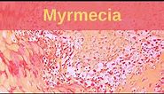 Deep Palmoplantar Wart (Myrmecia) - Pathology mini tutorial