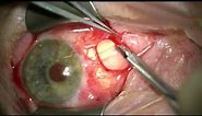 Transconjunctival excision of a conjunctival cyst