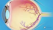 What is a Macular Pucker?