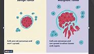 Pathology 192 a Define Benign Malignant Tumor Neoplasia Differences Compare Comparison Vs