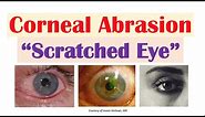 Corneal Abrasion (“Scratched Eye”) | Causes, Signs & Symptoms, Diagnosis, Treatment