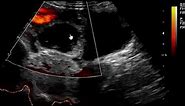 Hemorrhagic Corpus luteum cyst on Ultrasound scan