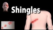 Shingles: Pathophysiology, Symptoms, 3 stages of Infection, Complications, Management, Animation.