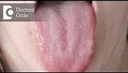 Diagnosis for red lesions present on tongue surface - Dr. Jayaprakash Ittigi