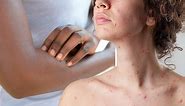 Chickenpox: NHS doctor advises how to treat rash