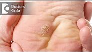 What causes of warts on hands and feet? - Dr. Urmila Nischal