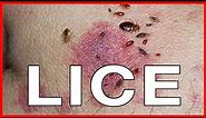 Pubic Lice or Crabs: Info about Transmission, Treatments, Cure and Pictures