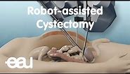 Robot-Assisted Cystectomy