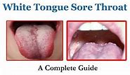 White Tongue Sore Throat - A Complete Guide