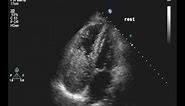 Carcinoid w/Positive Bubble