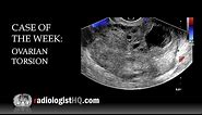 Case of the Week: Ovarian Torsion (Ultrasound)