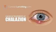 Chalazion | Causes, Treatment and Surgery