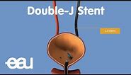 JJ Stent (removal of kidney stones)