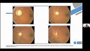 Evaluación del Nervio Optico en glaucoma y otras neuropatias. Dr W Loayza Dra Inga