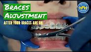 How Do Braces Straighten Teeth?