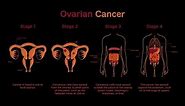 Stages of Ovarian Cancer