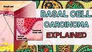 Basal Cell Carcinoma Explained - Causes, Types (Nodular/Sclerotic/Superficial), Histology, Treatment