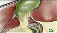 Gallbladder Removal Laparoscopic Surgery Patient Education
