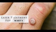 Warts removal with Laser Treatment | Dr. Chiam CT