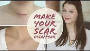 HOW TO FADE SURGERY SCARS | Thyroidectomy | Scar Care | Graves' Disease