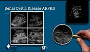 Renal Cysts Ultrasound