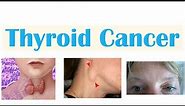 Thyroid Cancer (Papillary, Follicular, Medullary & Anaplastic) | Symptoms, Diagnosis, Treatment