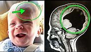Boy Born Without A Brain, 6 Years Later Look At What Doctors Find Inside....